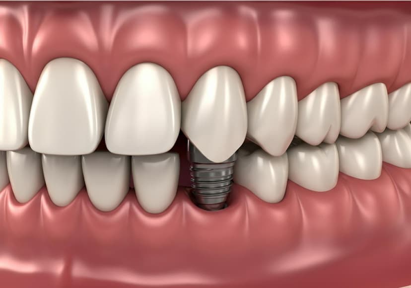 Dental Implants Are They Right For You Overview